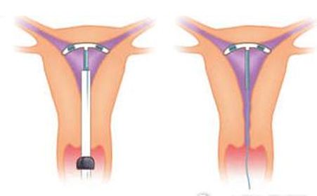 节育环什么时候摘合适(图2)